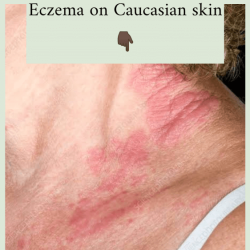 caucasian-skin